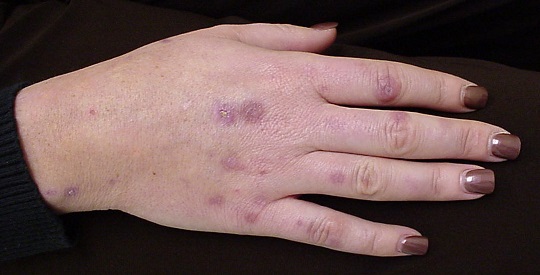 Common Blood Pressure Drugs Increase Skin Cancer Risk Seven-Fold!