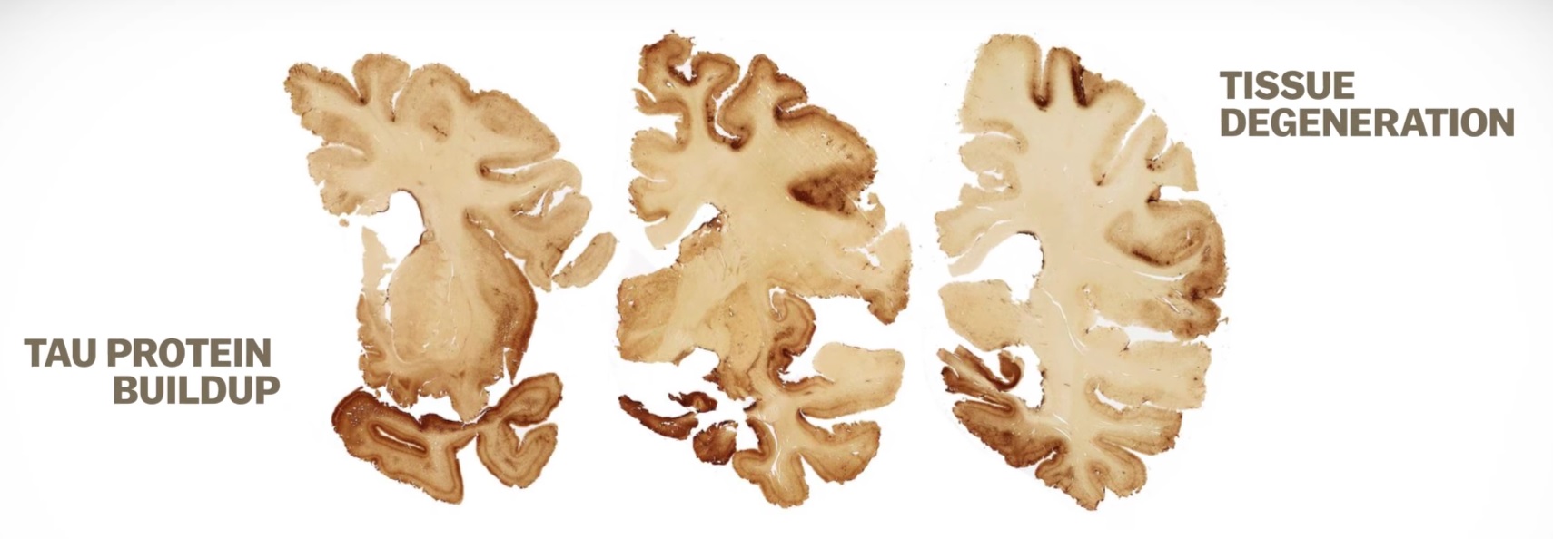 Concussion & CTE (Chronic Traumatic Encephalopathy) FULL HEALTH SECRETS