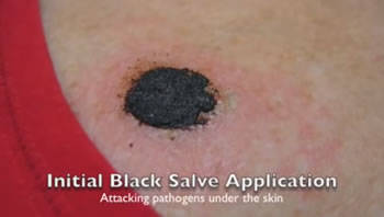 Black Salve for Skin Cancer