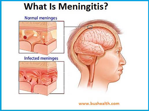 EFFECTIVE NATURAL WAYS TO TREAT MENINGITIS