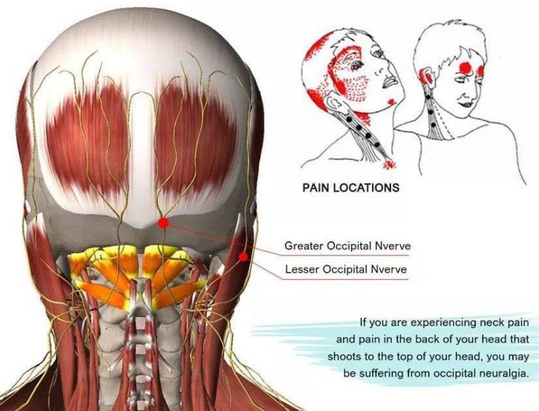 Occipital Neuralgia FULL HEALTH SECRETS